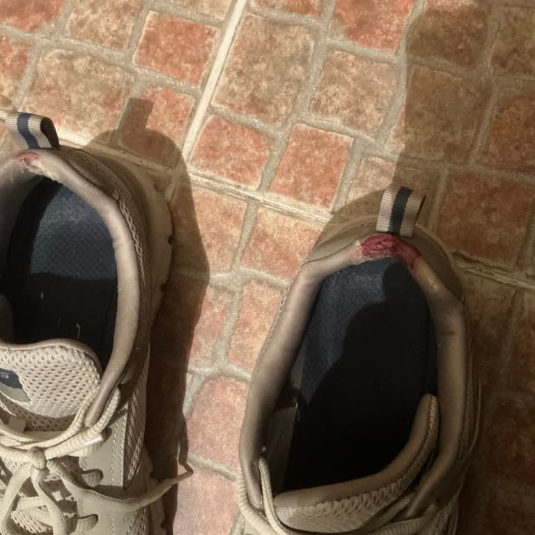 Skechers Ayakkabısının Topuk Bölgesi Tahrişi Ve Kanamalara Neden Olması