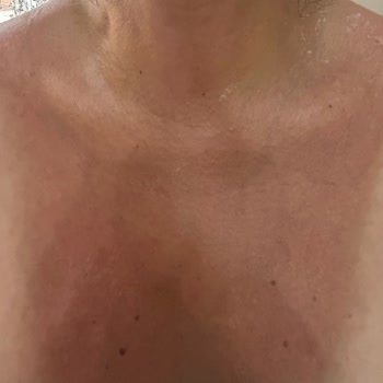 Arko Güneş Kremi Yanıklara Neden Oldu, İncelenmesini Ve Telafi İstiyorum
