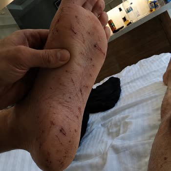 Balayı Tatilinde Kıyı Taşları Ayağımı Kesti Ve Otel Yönetimi İhmalkar Davrandı