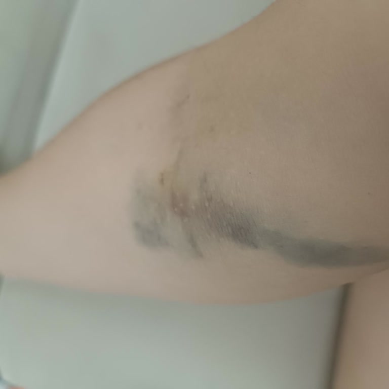 Zor Damarlar Nedeniyle Şiddetli Acı Ve Kaba Hemşire Tavırları