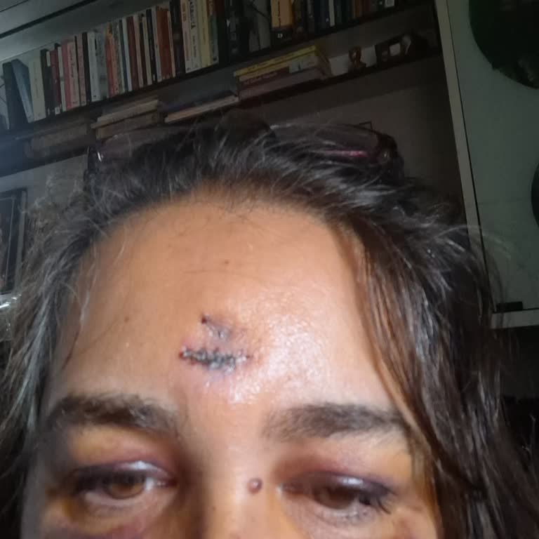 Ankara Eğitim Hastanesinde Yetersiz Bakım Ve Tekrarlanan Ameliyatlar