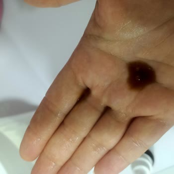 Koyu Kahverengi Ve Kötü Kokulu Serumun İadesi