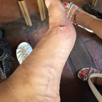 Ugg Golden Glow Sandaletinde Su Birikmesi Ve Ayak Yarası
