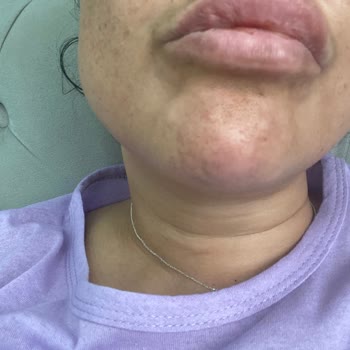 Si Beauty’de Hijyen Ve Yetkisiz İşlemler Nedeniyle Sağlık Sorunları Yaşadım