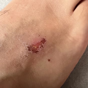 Beymen'de Valentino Ayakkabısında Cilt Yanıkları Ve Değişim Talebi