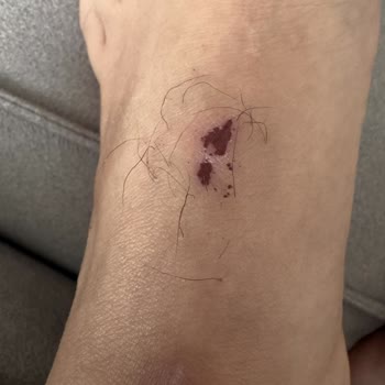 Beymen'de Valentino Ayakkabısında Cilt Yanıkları Ve Değişim Talebi