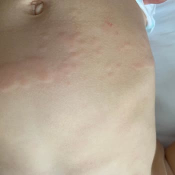 Molfix 6 Numaralı Külot Bezinde Cilt Tahrişi Ve Kızarıklık