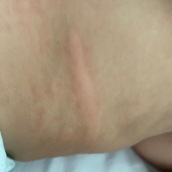 Molfix 6 Numaralı Külot Bezinde Cilt Tahrişi Ve Kızarıklık