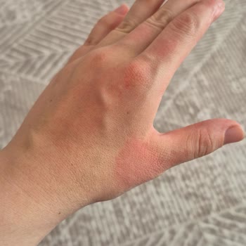 Parfüm Testeri Cildimde Yanma Ve Kızarıklığa Neden Oldu, Kontrol Ve Telafi Talebi