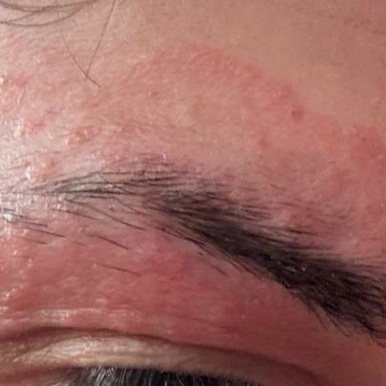 Yanlış Tanı Ve Tedavi Nedeniyle Çocukta Cilt Sorunları Ve Çözüm Beklentisi