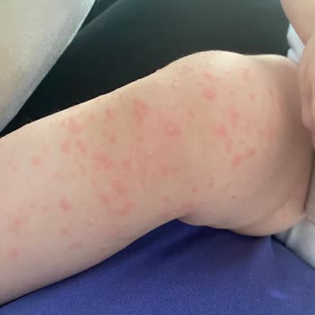 Alerjik Reaksiyon Ve Hastane İletişimsizliği Çocuğumun Sağlığını Tehlikeye Atıyor