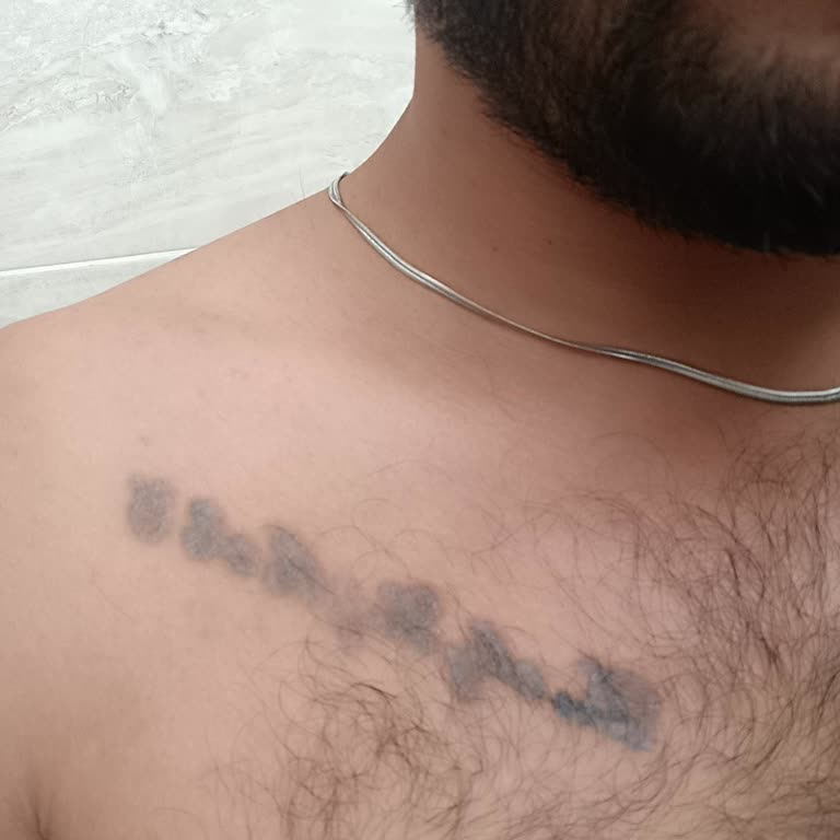 Dövme Silme Seansları Etkisiz, 7 Bin TL Geri Ödeme İstiyor