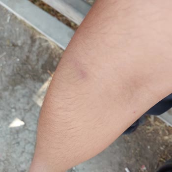 Kan Alınamayan Ve Çoklu İğne Girişiyle Hastanın Yaşadığı Mağduriyet