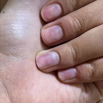 İşlem Sırasında Yanma Ve Tırnak Deformasyonu, İşletmenin Sorumluluk Reddi