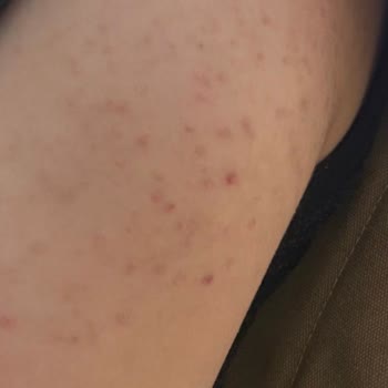 Vaseline Losyonundan Şiddetli Cilt Reaksiyonu Ve Kalıcı İzler