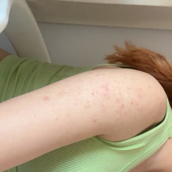 Vaseline Losyonundan Şiddetli Cilt Reaksiyonu Ve Kalıcı İzler