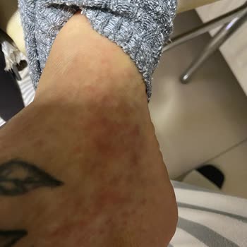 Fiyat Artışı Ve Hijyen İhlali Nedeniyle Lazer Epilasyonda Ciddi Mağduriyet