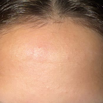 Diadermine Anti-Wrinkle Cream Purchased Online Caused Sudden Facial Breakouts