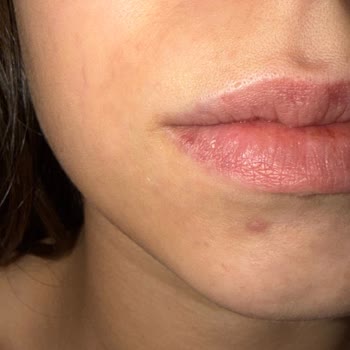 Diadermine Anti-Wrinkle Cream Purchased Online Caused Sudden Facial Breakouts