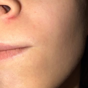 Diadermine Anti-Wrinkle Cream Purchased Online Caused Sudden Facial Breakouts