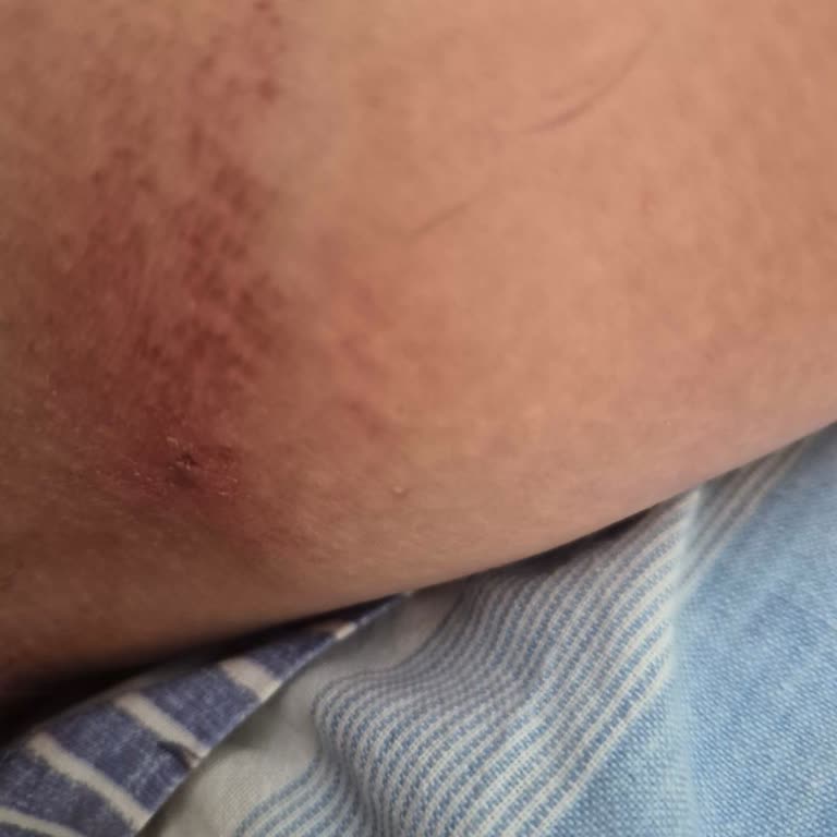 Penti Mağazasında Alerjik Bikini Ve İade Süreci Sorunu