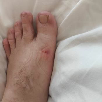 Ayağa Zarar Veren Skechers Sandaletinde İade Talebi