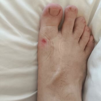 Ayağa Zarar Veren Skechers Sandaletinde İade Talebi