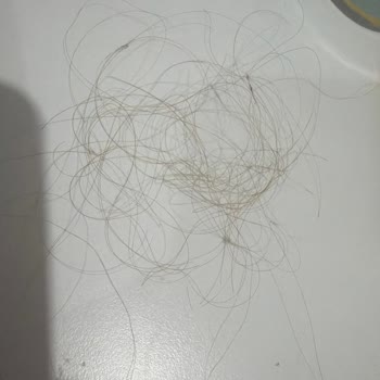 Ağır Kanama Ve Saç Dökülmesi Nedeniyle Yaşadığım Mağduriyet