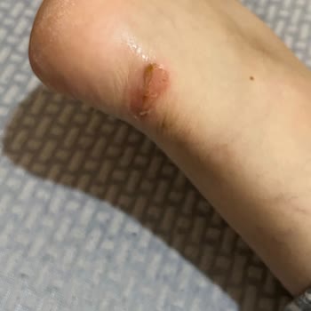 Ayakkabının Boyası Çoraba Geçti Ve Topuk Yarası Oluştu, İade Talebim Reddedildi