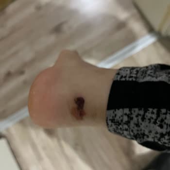 Ayakkabının Boyası Çoraba Geçti Ve Topuk Yarası Oluştu, İade Talebim Reddedildi