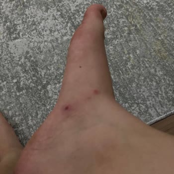 Crocs Terliği İç Parçası Sürtünme Ve Ağrıya Neden Oluyor