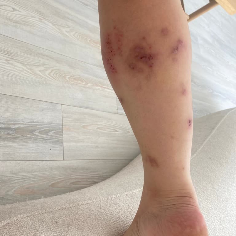 Cildiye Bölümünde Yanlış Uyuz Teşhisi Sonucu Şiddetli Mağduriyet