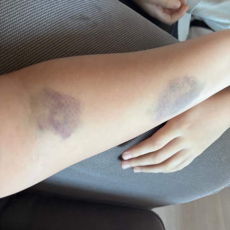 Şişli Kolan Hastanesi Acil Serviste Yanlış Damar Yoluyla Şiddetli Morluk Ve Şişlik