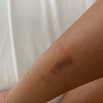 Düğün Öncesi Lazer Yanığı Ve Su Toplanması