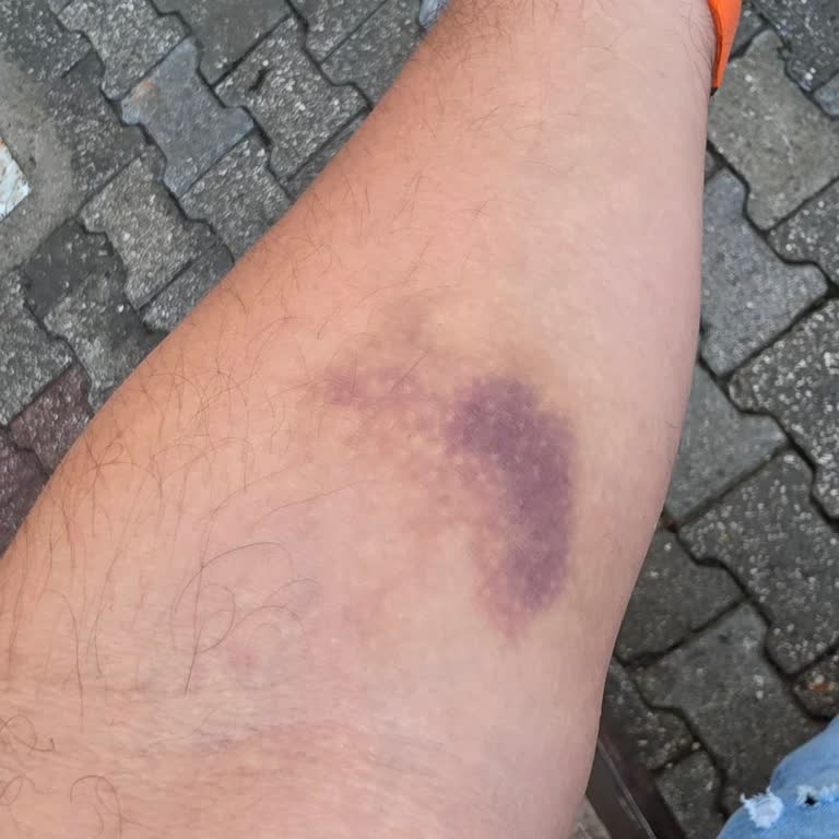 Adana Ceyhan Kızılay’da Kan Bağışı Sırasında Yaşanan Şiddetli Ağrı Ve İhmal