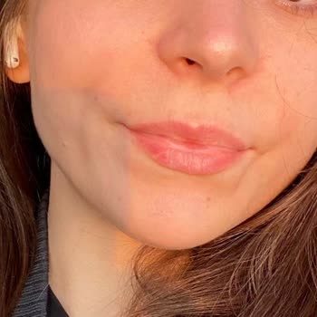 Yan Etki Nedeniyle Göz Ve Kulak Şikayetleri İle Kötüleşen Akne