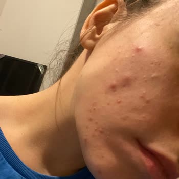 Yan Etki Nedeniyle Göz Ve Kulak Şikayetleri İle Kötüleşen Akne