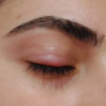 Life In Kaş Ve Kirpik Yağı Sonrası Gözde Şiddetli Arpacık Ve Görme Sorunu