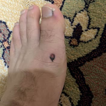 Ayıplı Ayakkabının Yara Yaratması Ve Uzun Süre Bekletilmesi