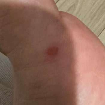 Ayak Ağrısı Ve Yara Oluşturan Stradivarius Topuklu Ayakkabı Şikayeti