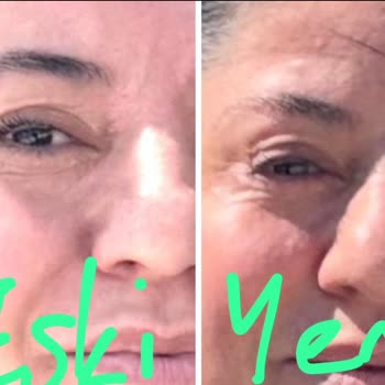 Göz Asimetrisi Nedeniyle Düzeltme Ameliyatı Ücretinin Karşılanması Talebi
