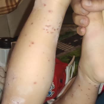Çocuğumun Yüksek Ateşli Hastaneye Yatması Ve Yanıltıcı Plaj Açıklamaları Nedeniyle Büyük Mağduriyet