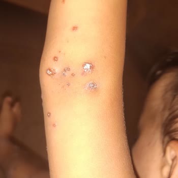Çocuğumun Yüksek Ateşli Hastaneye Yatması Ve Yanıltıcı Plaj Açıklamaları Nedeniyle Büyük Mağduriyet