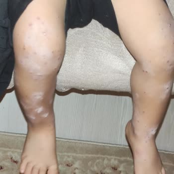 Çocuğumun Yüksek Ateşli Hastaneye Yatması Ve Yanıltıcı Plaj Açıklamaları Nedeniyle Büyük Mağduriyet