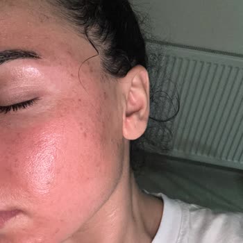 Yves Rocher Temizleme Jelinde Cilt Yanması Ve Kızarıklık Şikayeti