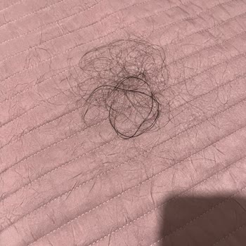 Elidor Şampuanında Köpürme Sorunu Ve Şiddetli Saç Dökülmesi