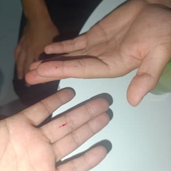 Kırık Kapak Yüzünden Parmak Kesildi: Sırma Koruk İçeceği