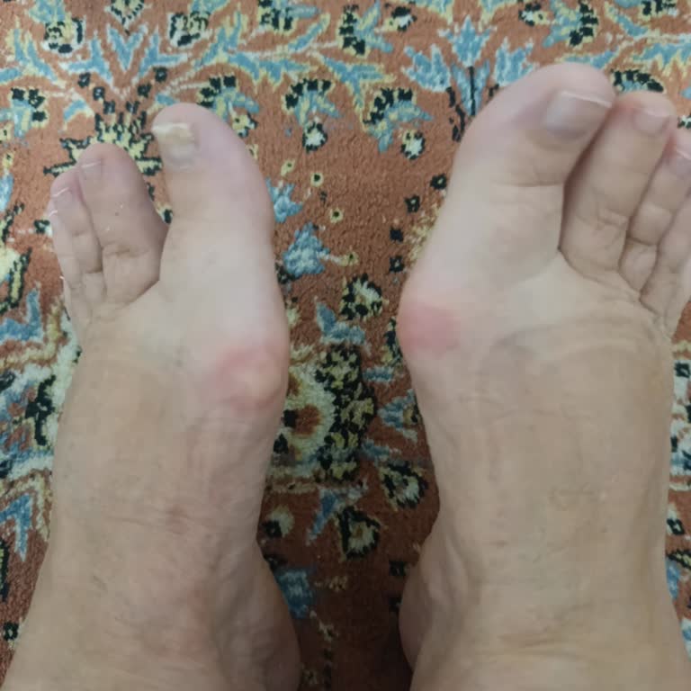 Ayak Sağlığına Zarar Veren Ayıplı Skechers Ayakkabı Ve Mağazanın Garanti Reddi