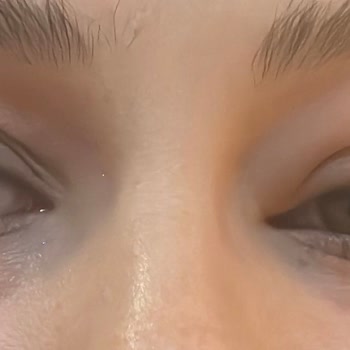 Flormar Volume Up Maskara'da Şiddetli Alerjik Reaksiyon Ve Acil Tıbbi Müdahale