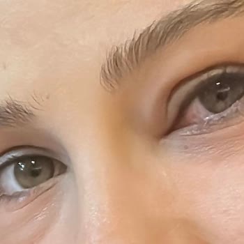 Flormar Volume Up Maskara'da Şiddetli Alerjik Reaksiyon Ve Acil Tıbbi Müdahale